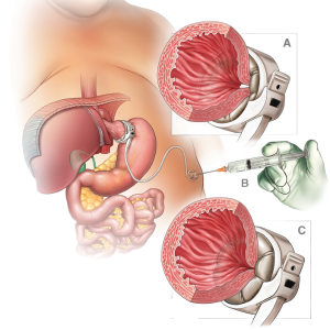 Adjustable Gastric Banding (Lap-Band Surgery)