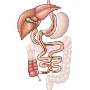Biliopancreatic Diversion with Duodenal Switch (BPD/DS)