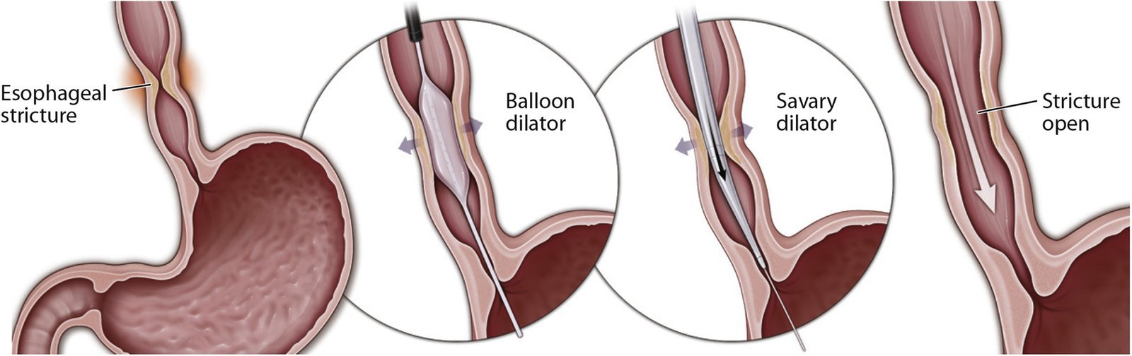 Corrosive Esophageal strictures