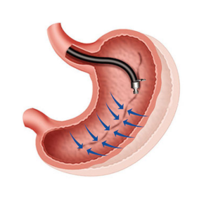 Endoscopic Sleeve Gastroplasty (ESG)
