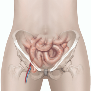 Fermoral Hernia Repair