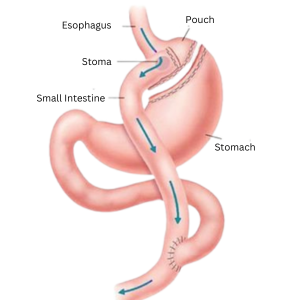 Gastric Bypass Surgery (Roux-en-Y)
