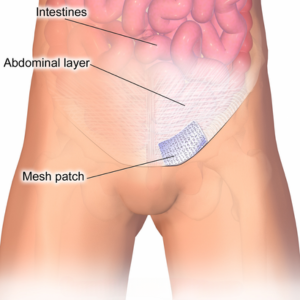 Mesh Repair