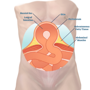 Hernioplasty