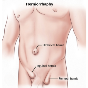 Herniorrhaphy