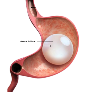 Intragastric Balloon