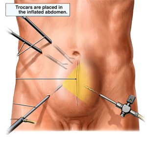 Laparoscopic Hernia Repair