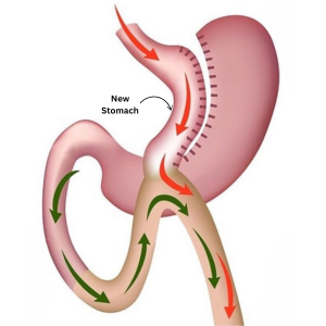 Mini-Gastric Bypass