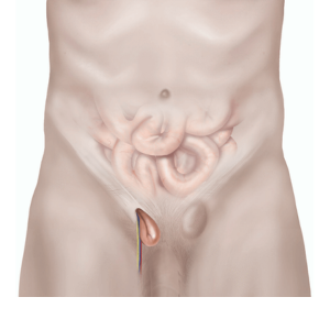Open Hernia Repair (Inguinal Hernia Surgery)