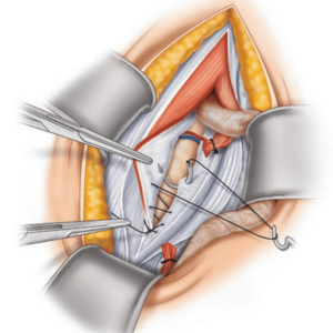 Shouldice Hernia Repair