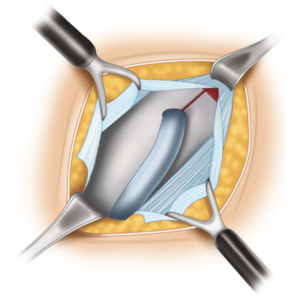 Tension-Free Hernia Repair