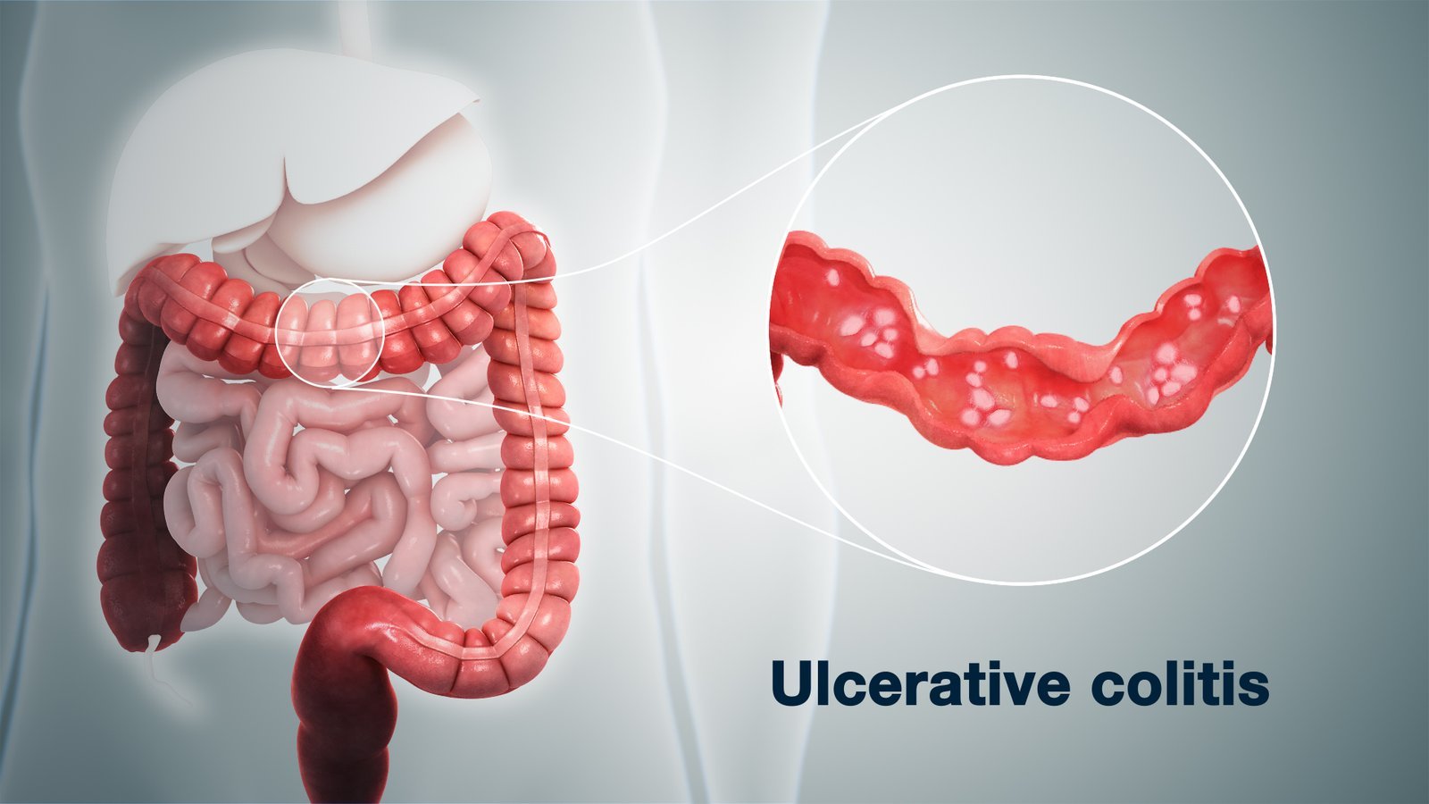 Ulcerative colitis/IBD