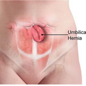Umbilical Hernia Repair