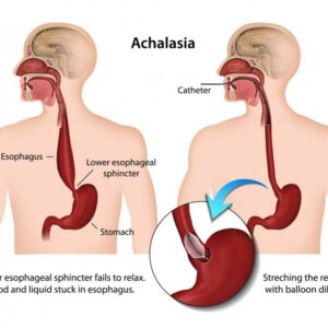 Esophageal Achalasia
