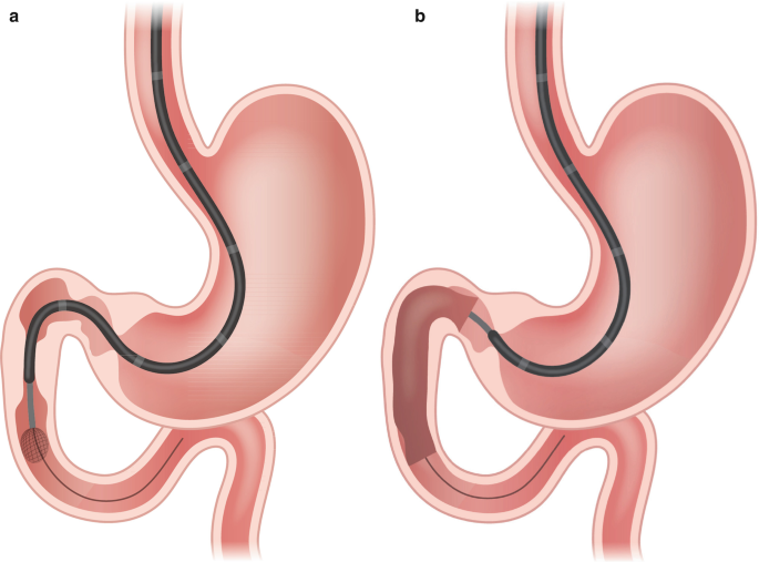 Gastric outlet obstruction