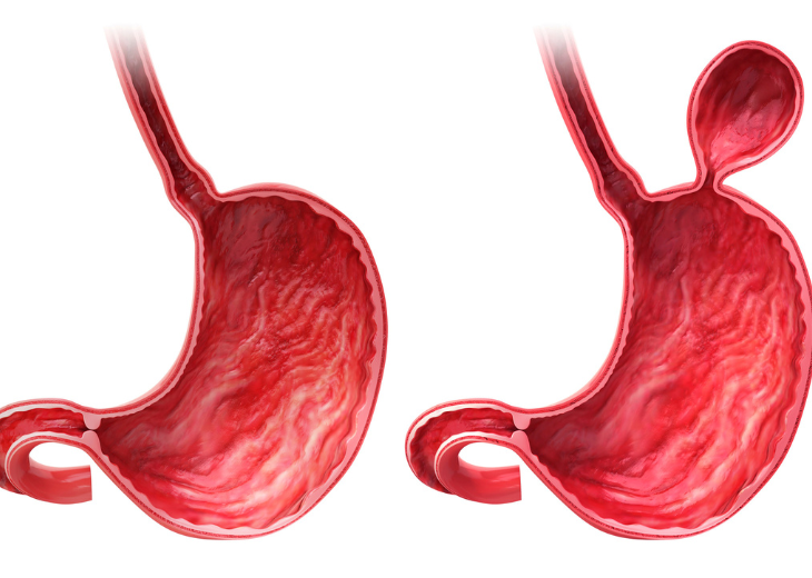 Best hernia specialist in Surat
